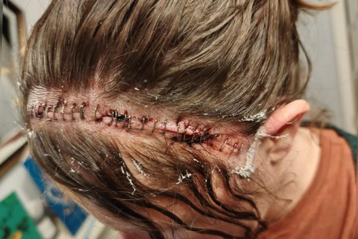 tumor-cerebral-2 Com dor de cabeça frequente, mulher descobre tumor cerebral de 15 anos