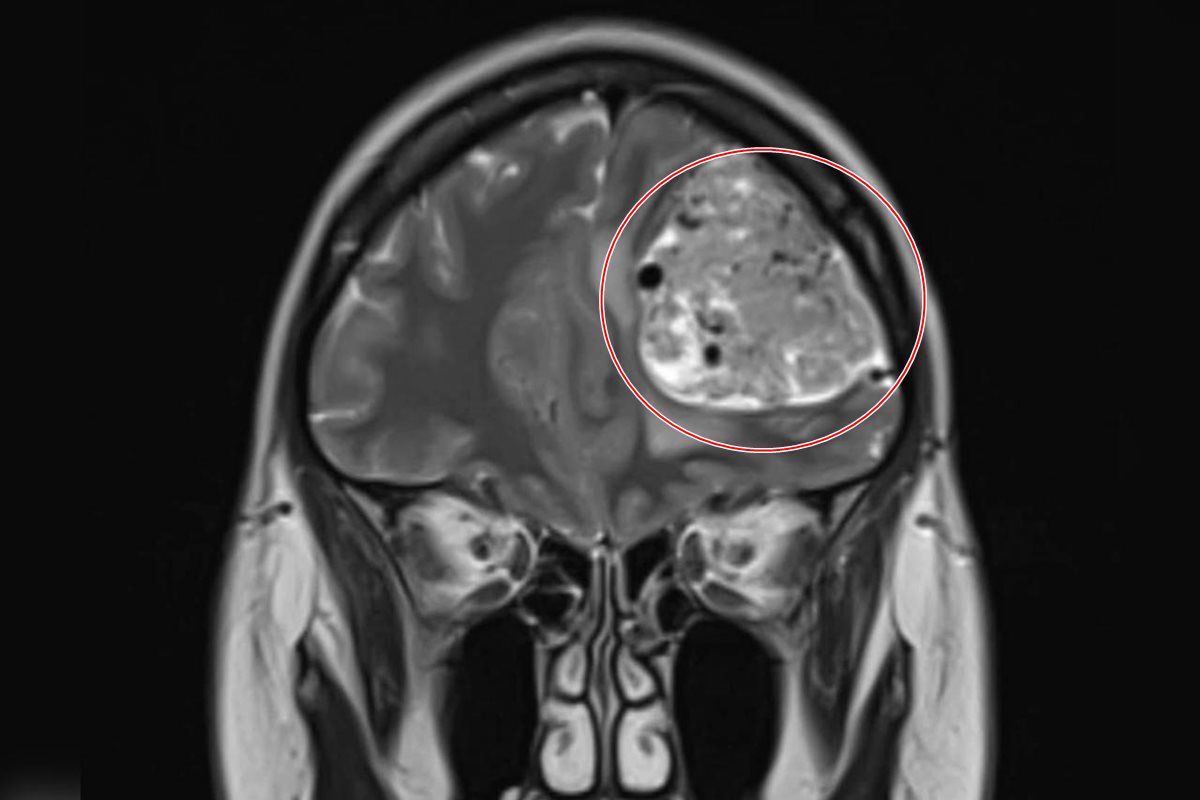 Com dor de cabeça frequente, mulher descobre tumor cerebral de 15 anos