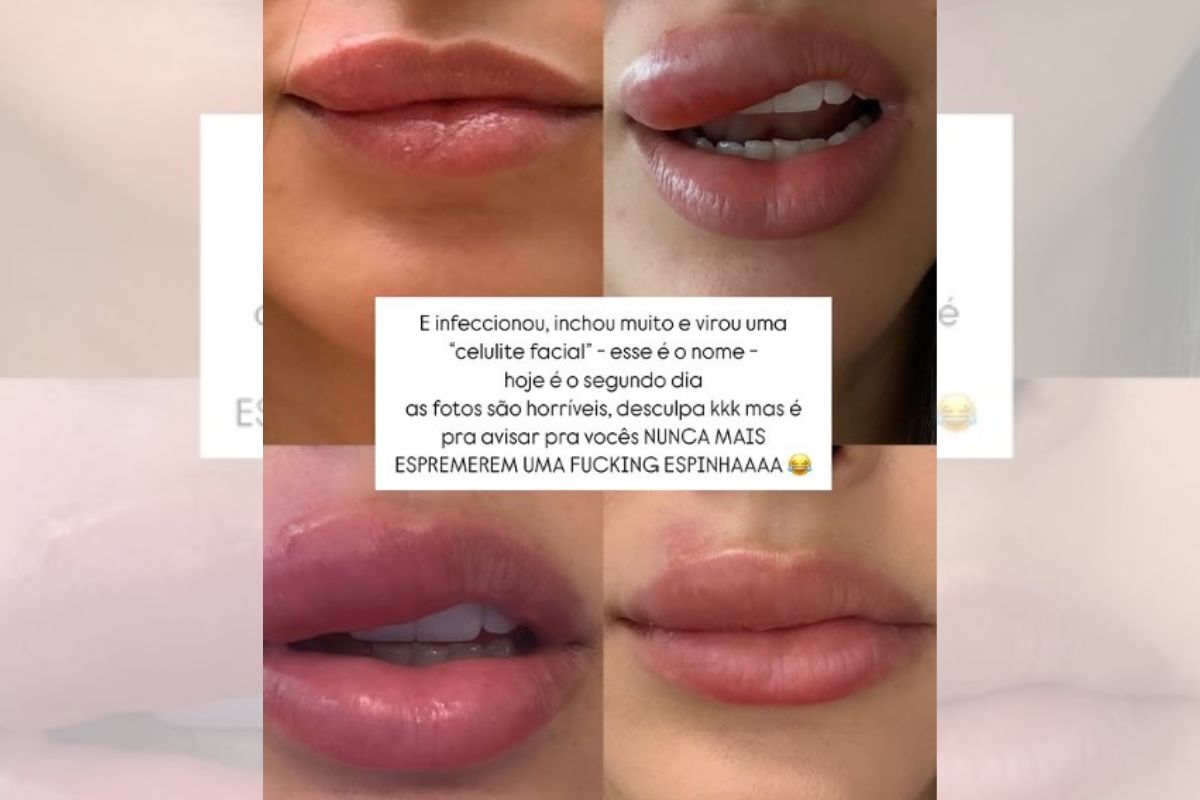 Color print of what Bruna Biancardi's mouth looked like after squeezing a pimple