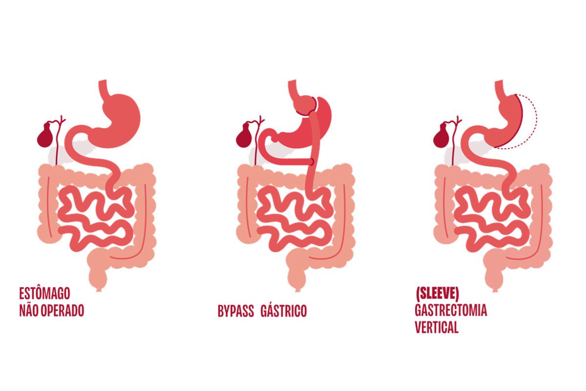Três ilustração de técnicas de cirurgia bariátrica - Metrópoles