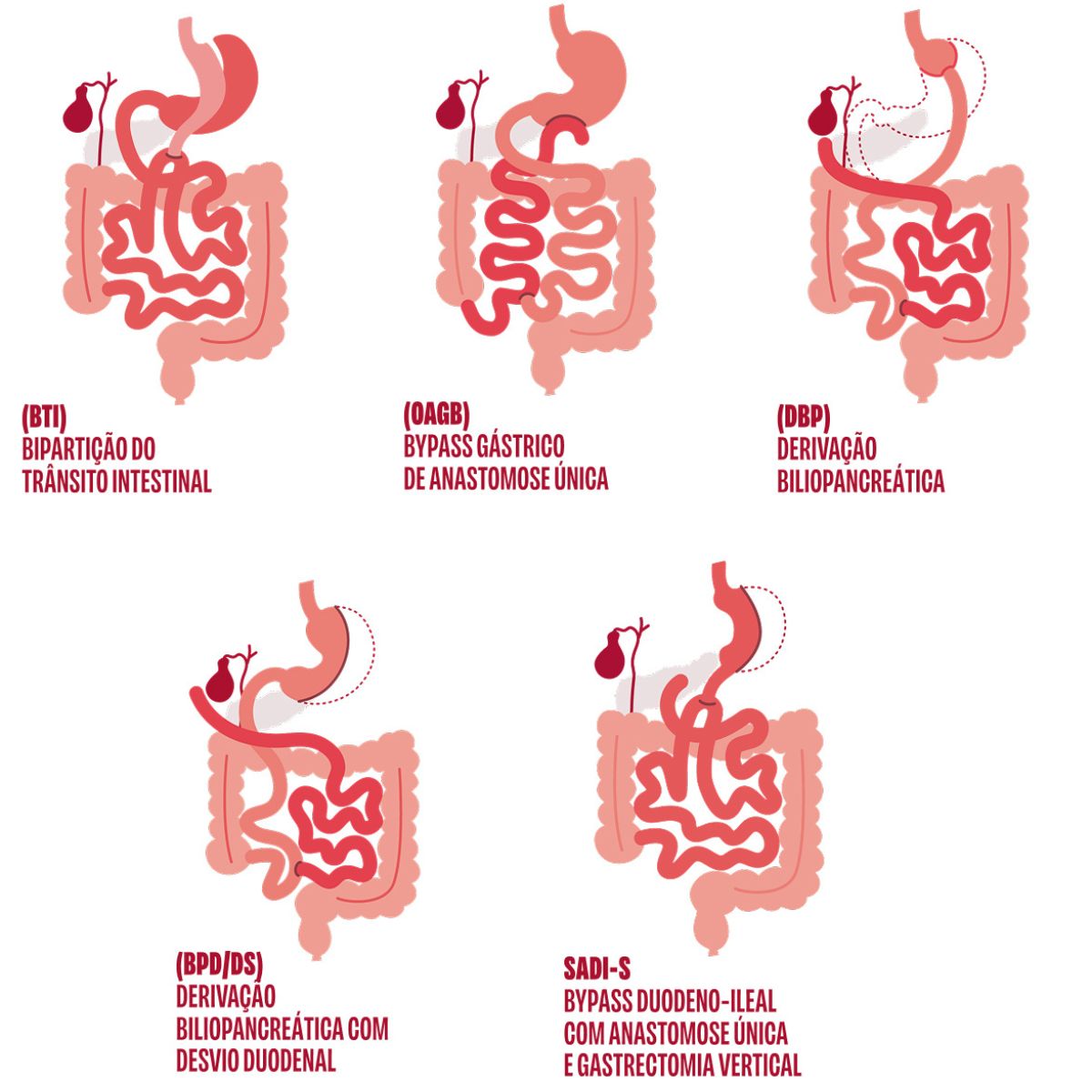Cinco ilustrações com técnicas de cirurgia baritátrica - Metrópoles