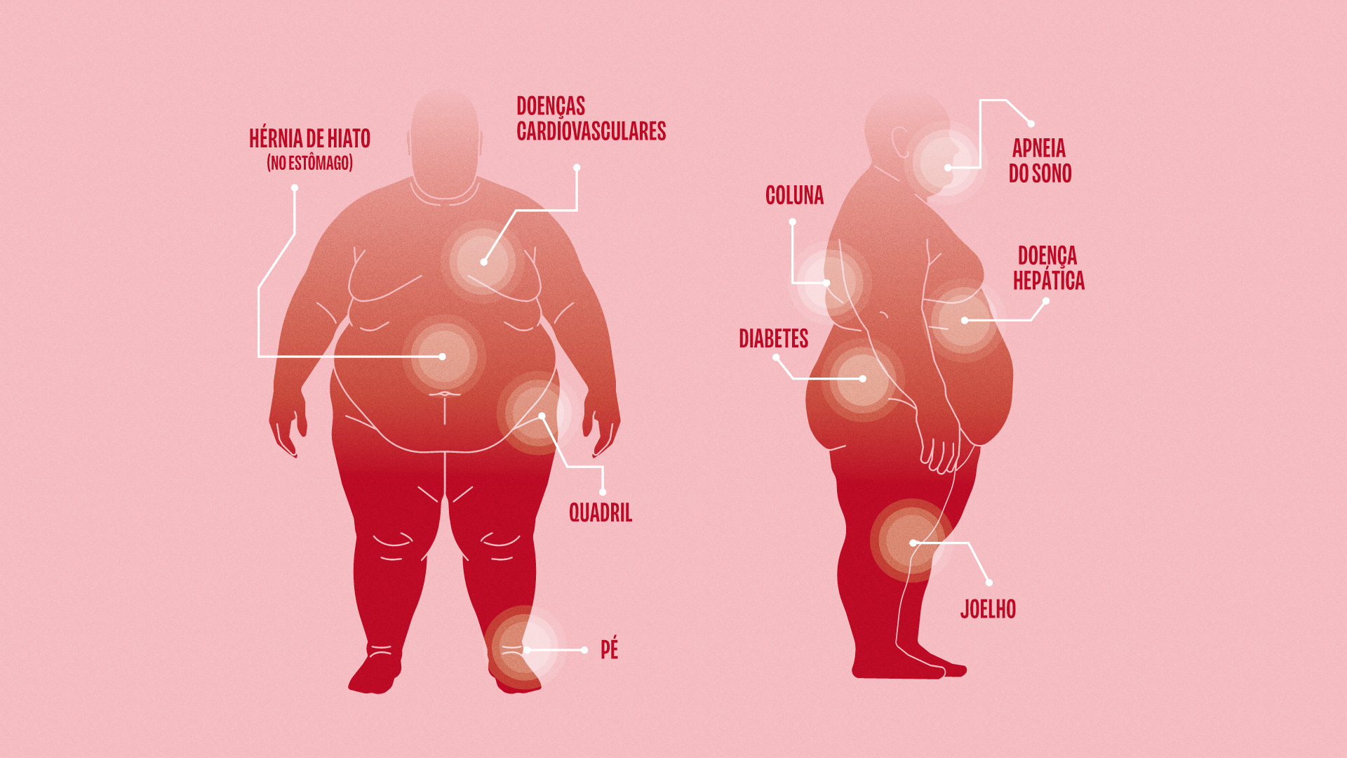 Ilustração de dois corpos com efeitos da superobesidade no corpo - Metrópoles