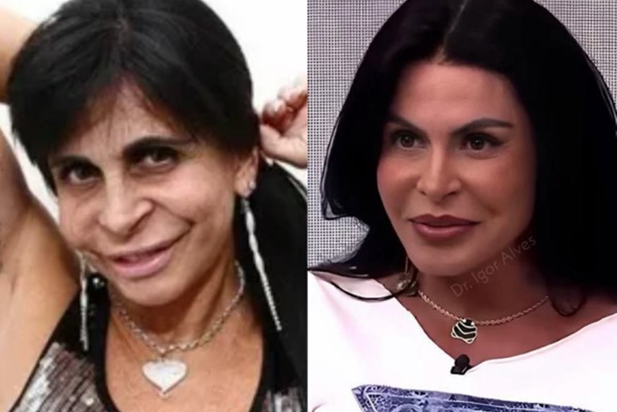 Blefaroplastia: quando investir no procedimento realizado por Gretchen