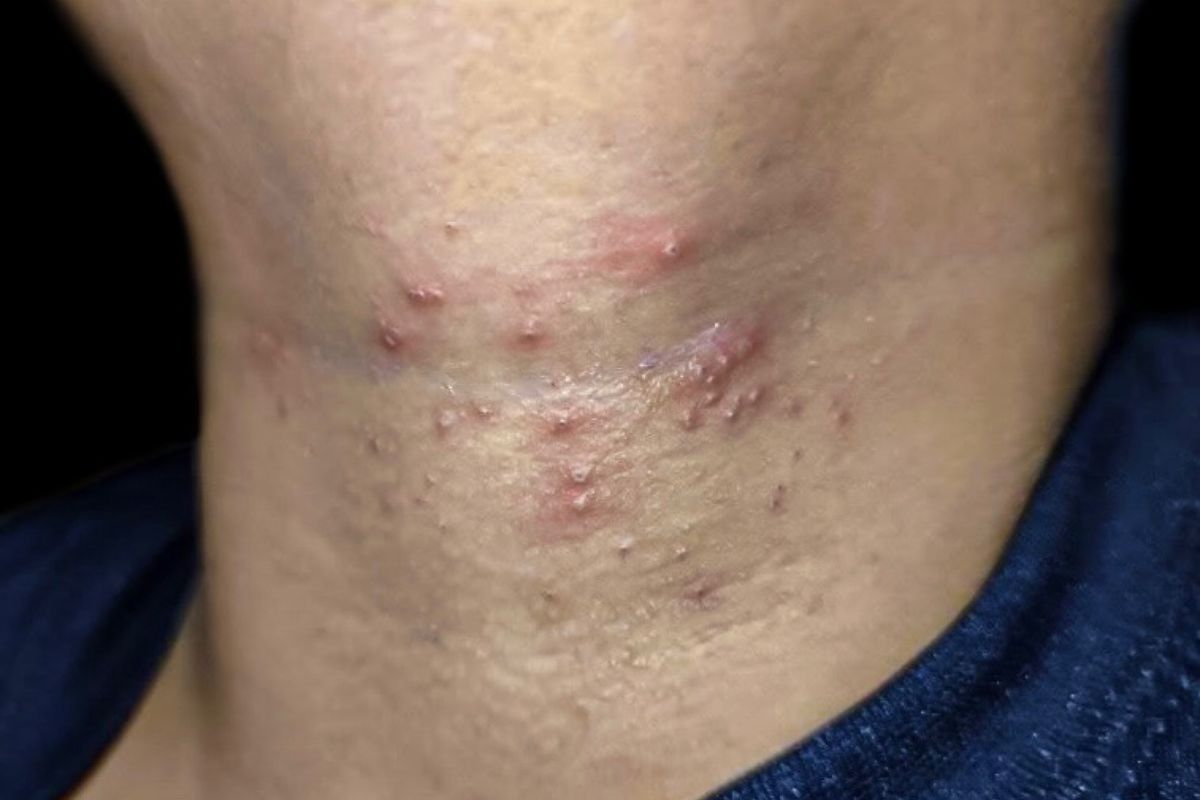 foto colorida foliculite em homem