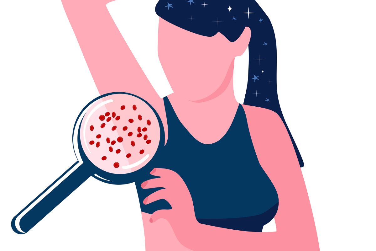 arte colorida de lupa dando zoom na foliculite de axila de mulher