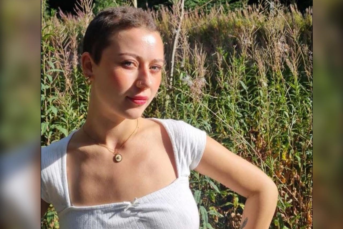 Choque! Jovem perde todo o cabelo após estresse no trabalho: Veja o que aconteceu!