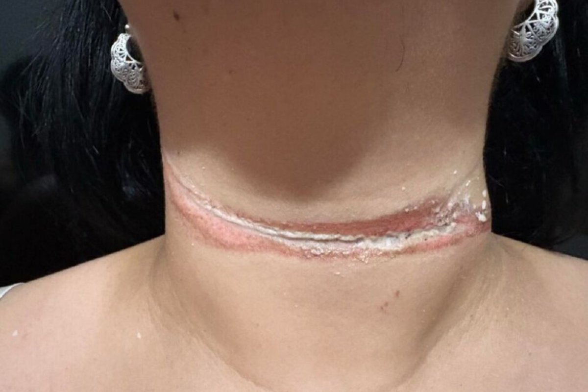 Professora quase é enforcada por fio de internet solto em MS